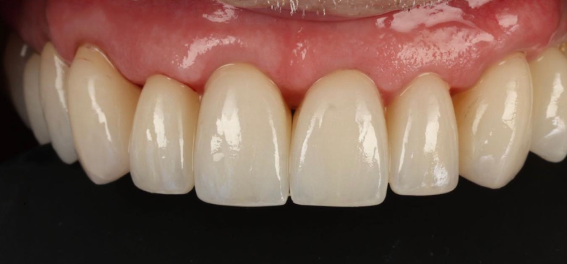 Bone Grafting after treatment